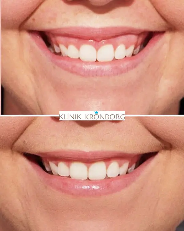 Behandling med Botox, Botox tandkødssmil, gummysmile