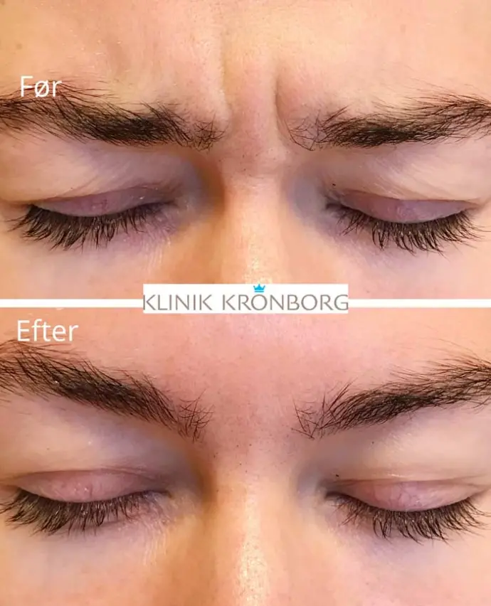 botox behandling i middelfart. før og efter